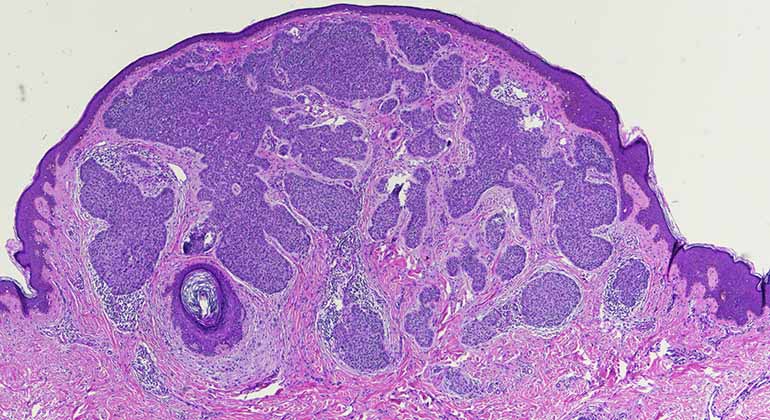 NYEE Pathology